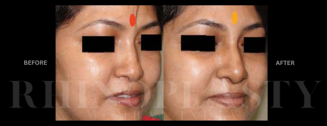 the best rhinoplasty surgeon in Mumbai