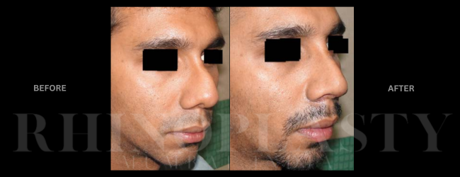 the best rhinoplasty surgeon in Mumbai