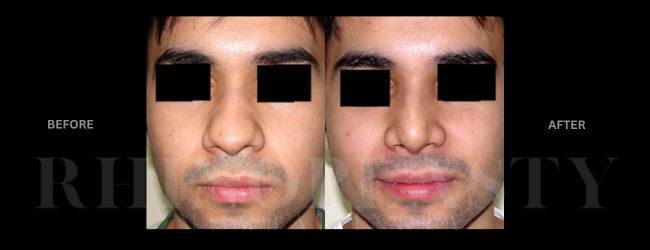 rhinoplasty mumbai