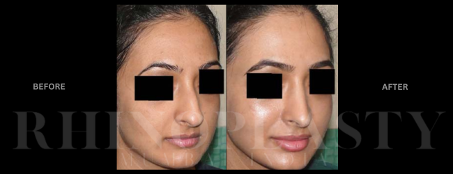 Rhinoplasty Mumbai
