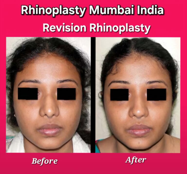 Revision rhinoplasty