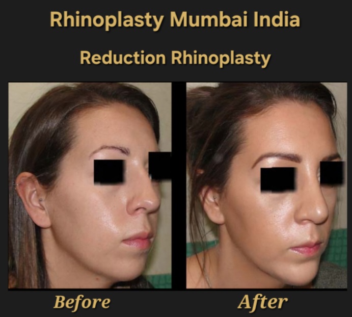 Rhinoplasty case No. 1