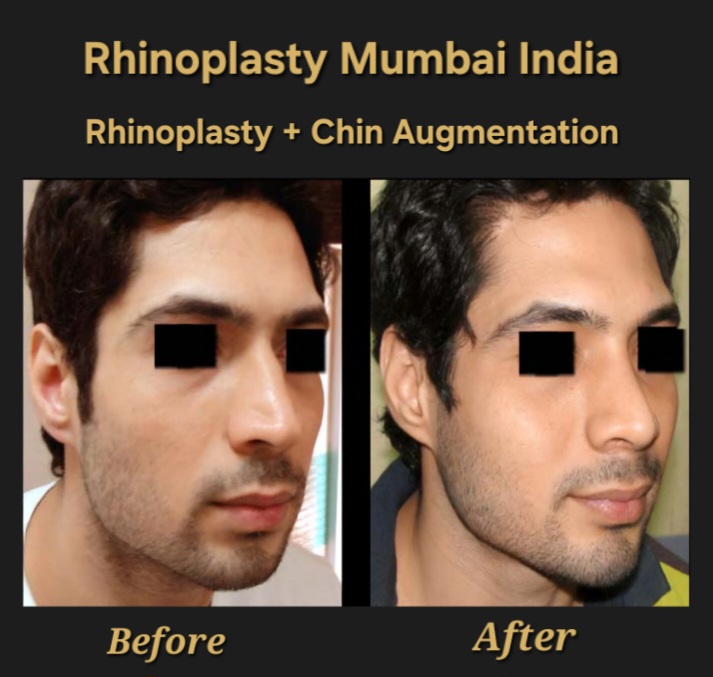 Rhinoplasty Case No. 2