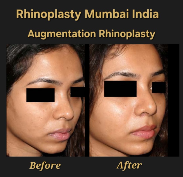 Rhinoplasty Case No. 3