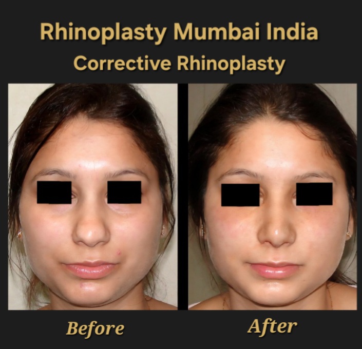 Rhinoplasty case no. 4