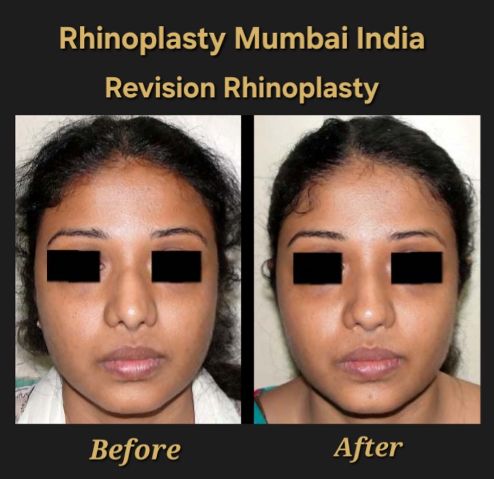 Rhinoplasty Case no. 5