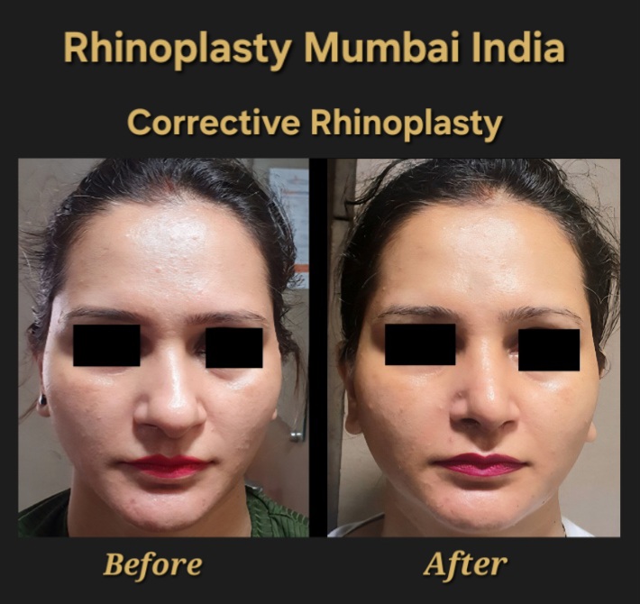 rhinoplasty case no. 6