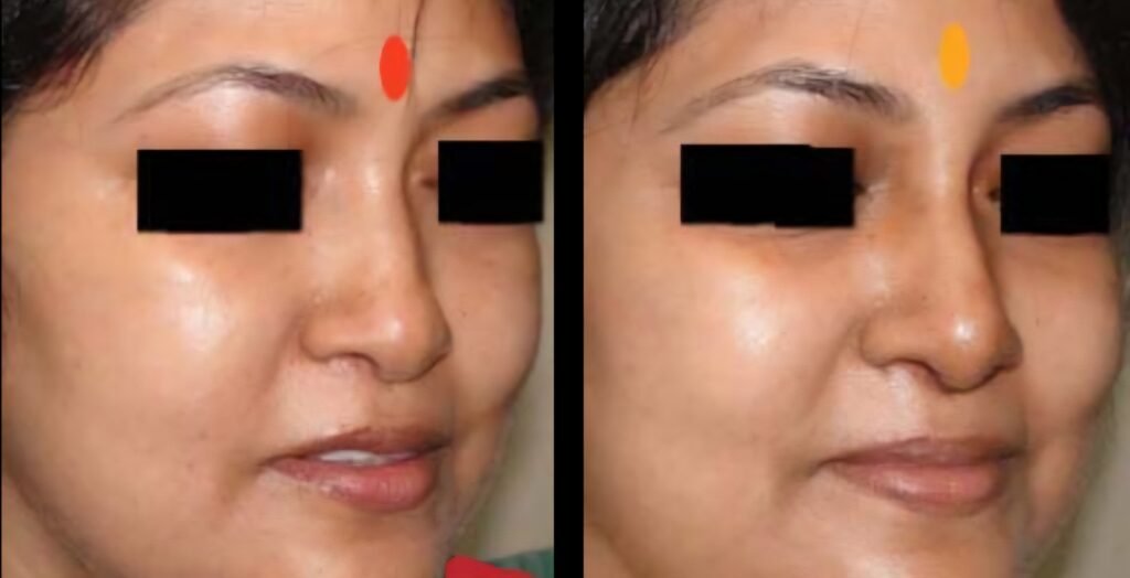 Augmentation Rhinoplasty