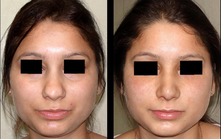 Corrective rhinoplasty