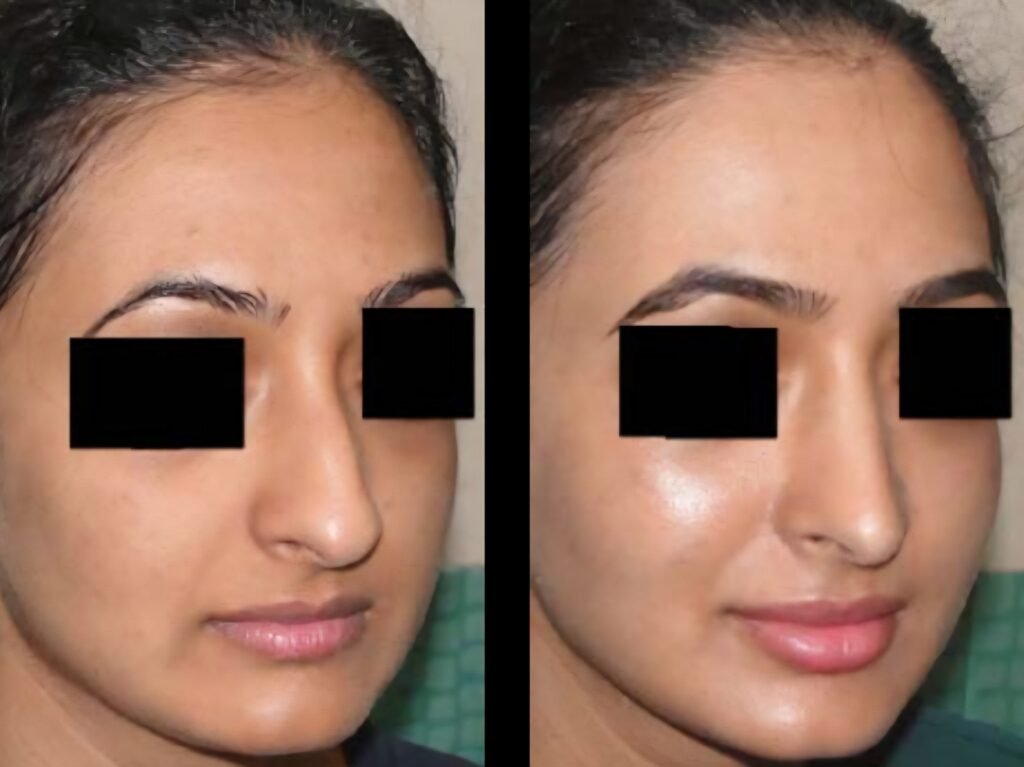 Reduction Rhinoplasty