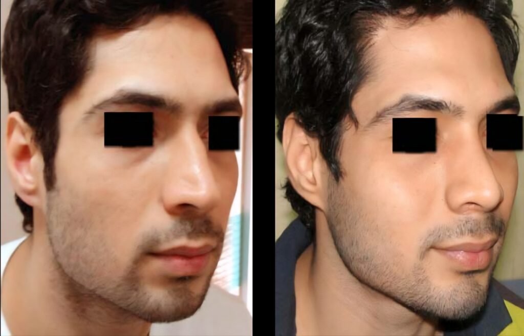 Rhinoplasty with Chin Augmentation