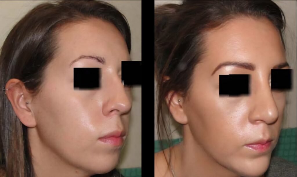 Primary Rhinoplasty