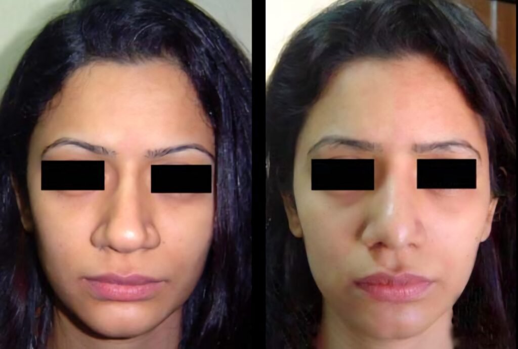 Revision Rhinoplasty